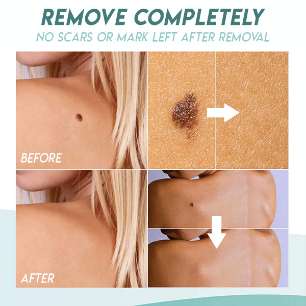 Beauty Patch™ Patch zum Entfernen von Hautflecken (36 Stück)