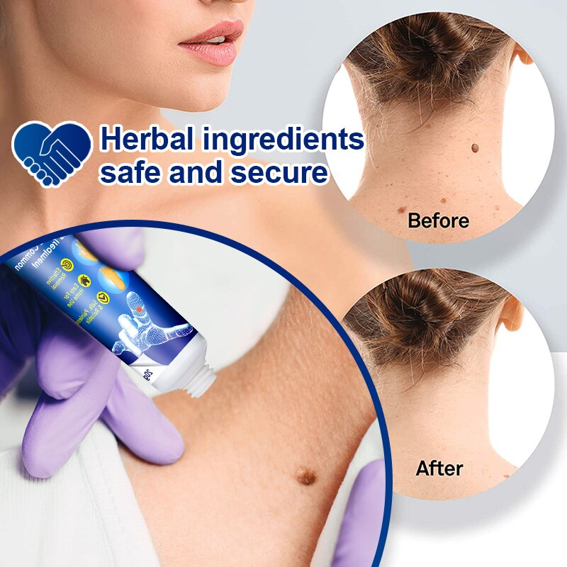 Skin Clear™ Hauttag-Entferner (1+1 gratis!)
