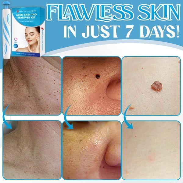 PureSkin™ Hauttag Entferner