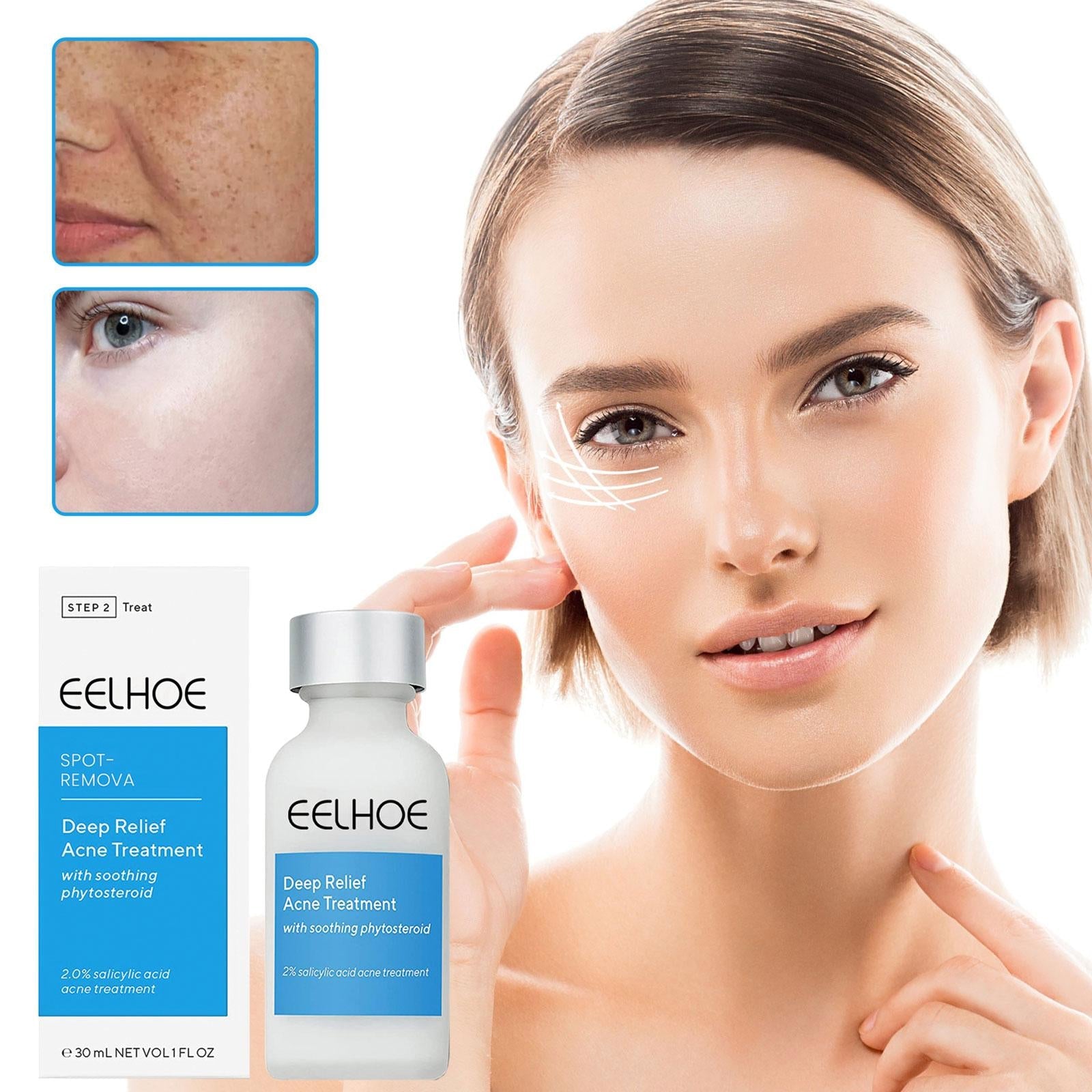 Eelhoe™️ I Lotion zur Behandlung von dunklen Flecken und Akne (1+1 GRATIS)