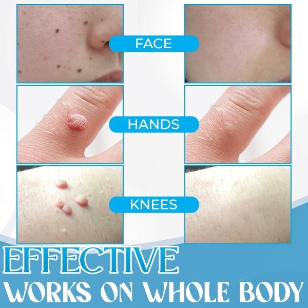 PureSkin™ Hauttag Entferner