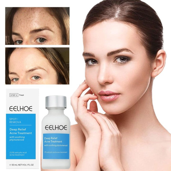 Eelhoe™️ I Lotion zur Behandlung von dunklen Flecken und Akne (1+1 GRATIS)