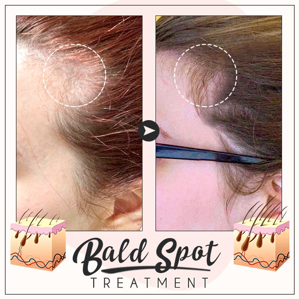 RevivePro™ Hair Boost Ingwer-Creme (1+1 GRATIS!)
