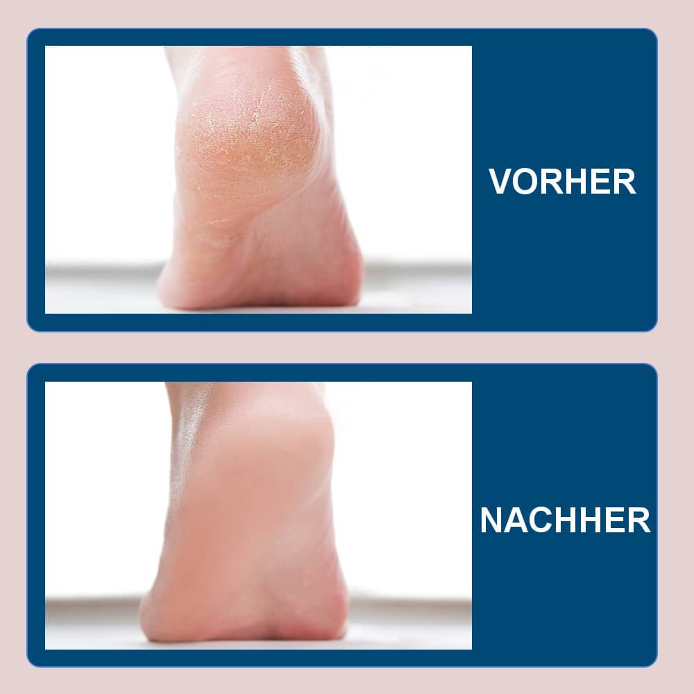 PediKure™ - Elektrischer Fußschwielenentferner