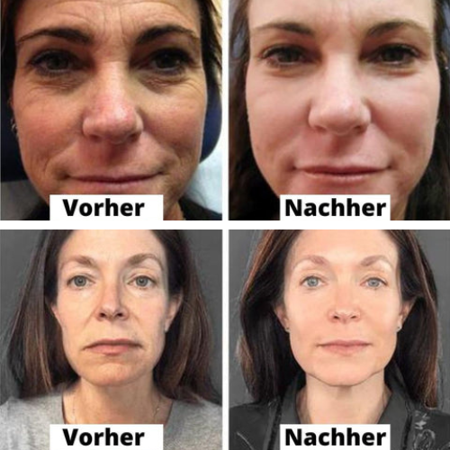 AntiAge™ - Waschfreie Kollagen Gesichtsmaske (10+10 GRATIS)