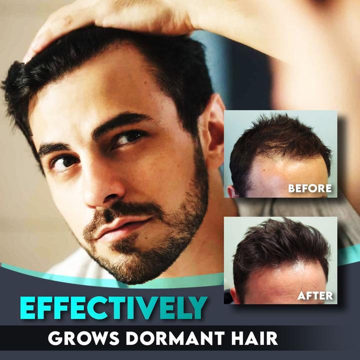 AlphaM™ Haarwuchs-Roller+Essenz (1+1 gratis!)