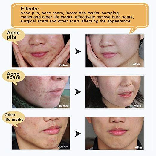 Scar Heal™ Creme zur Narbenentfernung