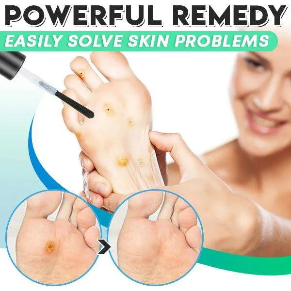 Corn Gel™ Gel zur Entfernung von Mais (1+1 GRATIS)