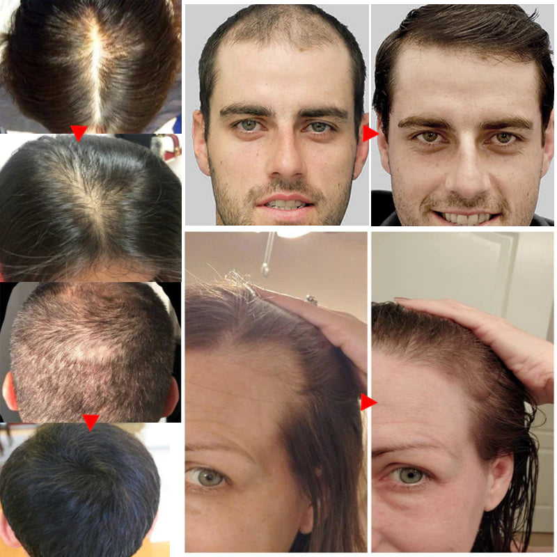 iBeaLee® I Haarwuchsöl (1+1 GRATIS)