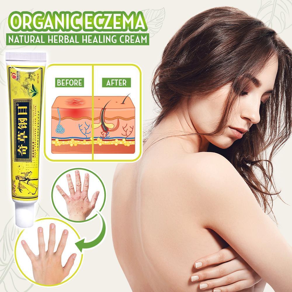 Organic Heal™ Bio Ekzem Natürliche Kräuter-Heilcreme (1+1 gratis!)