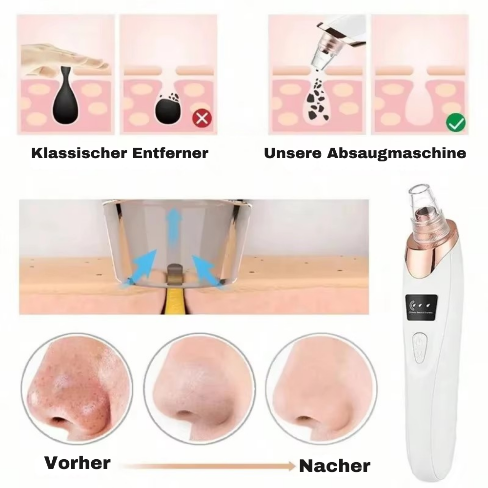PoreLuxe™ - Gesichts Mitesser Entferner Vakuum
