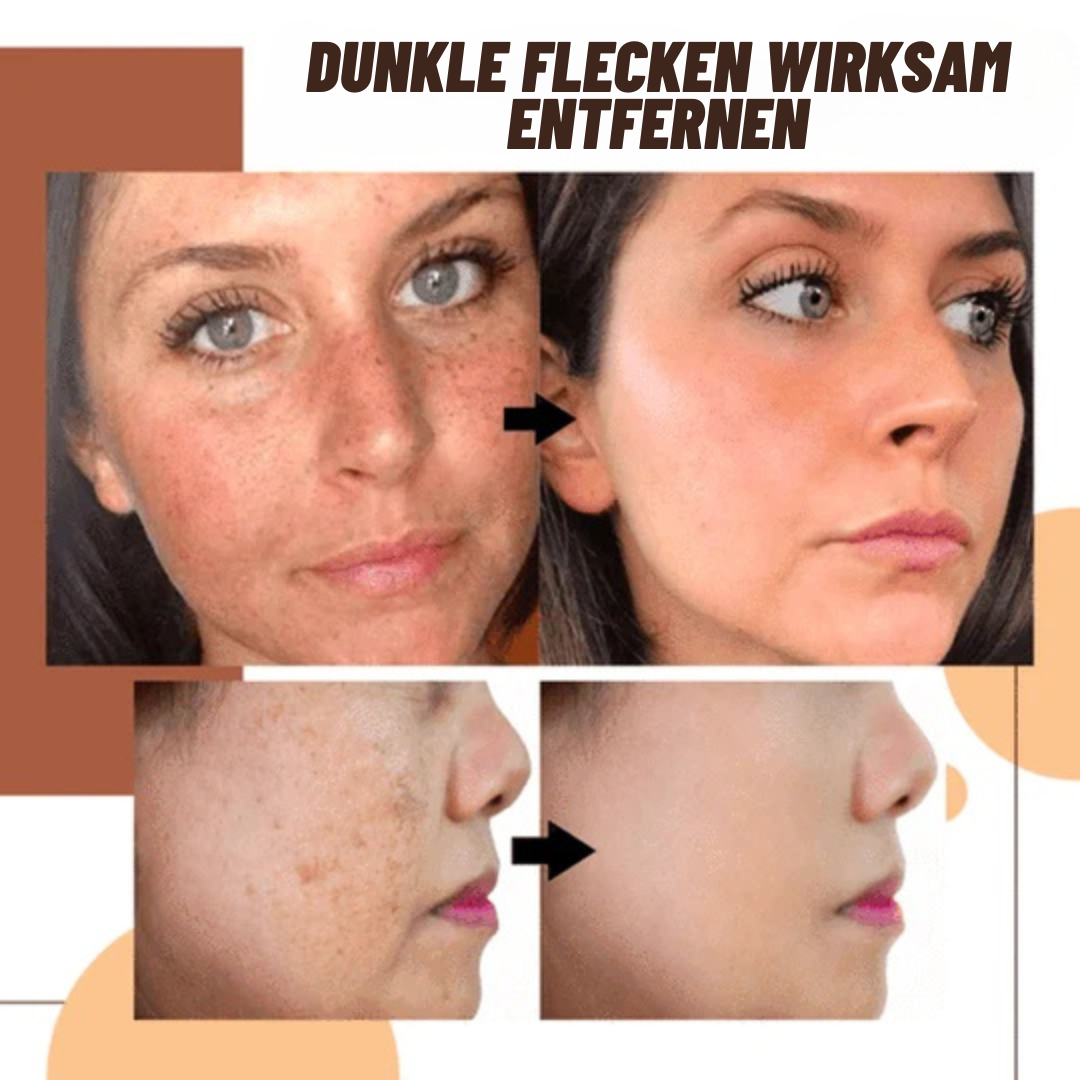 VENZEN™ Serum zur Korrektur dunkler Flecken (1+1 GRATIS)