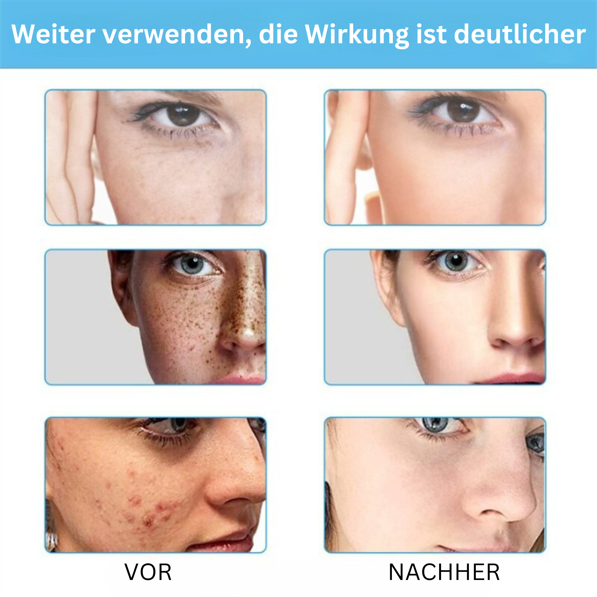 Eelhoe™️ I Lotion zur Behandlung von dunklen Flecken und Akne (1+1 GRATIS)