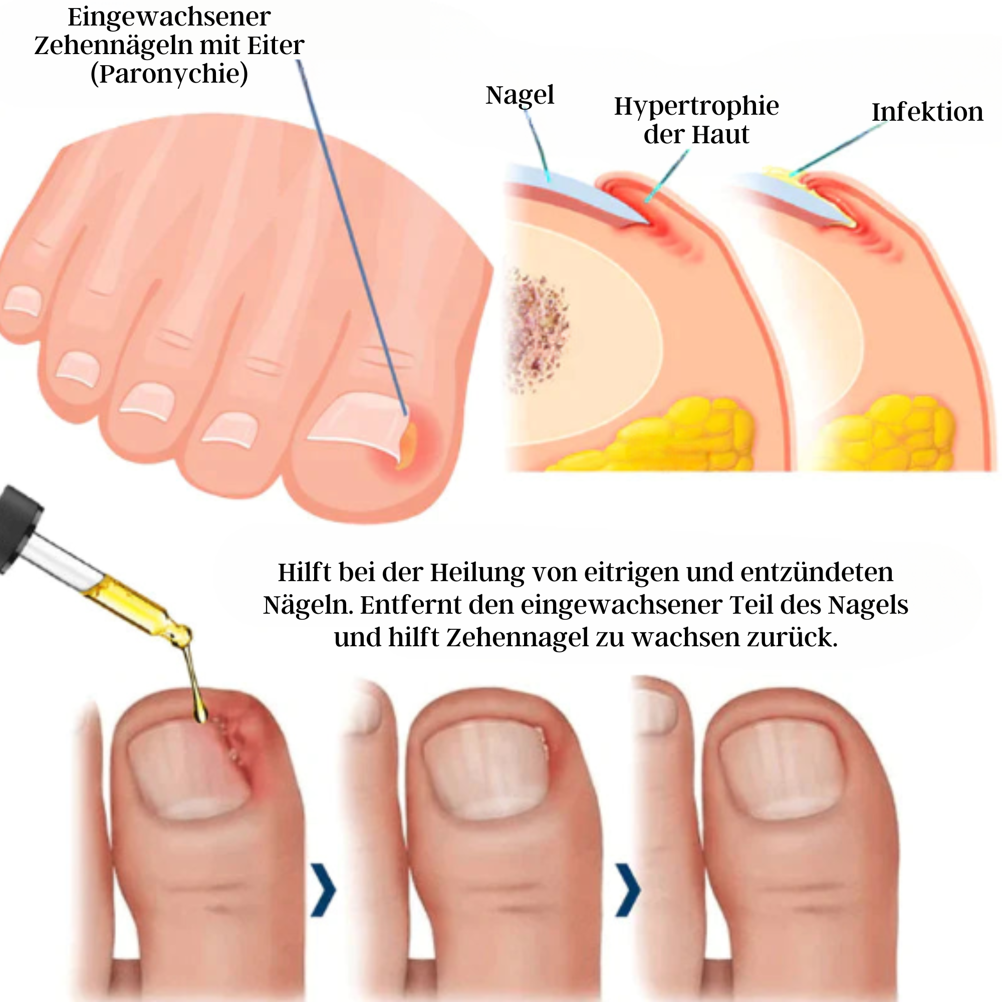 Jaysuing™️ I Anti-paronychie-Erleichterungsöl (1+1 GRATIS)