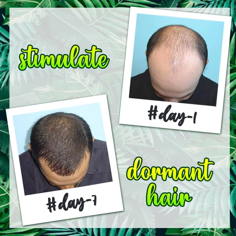 Miracle Grow™ 7X Schnelles Haarwachstumsserum (1+1 GRATIS)